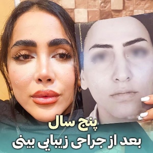 rhinoplasty-832