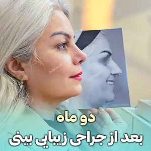 rhinoplasty-834
