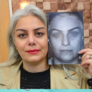 rhinoplasty-835