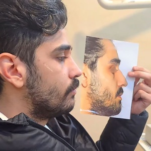 rhinoplasty-837