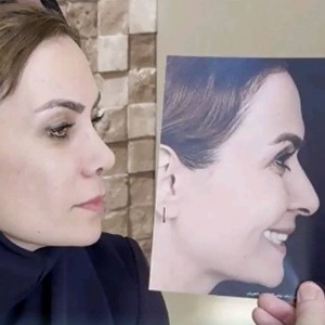 rhinoplasty-838