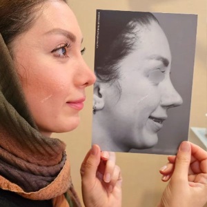 rhinoplasty820