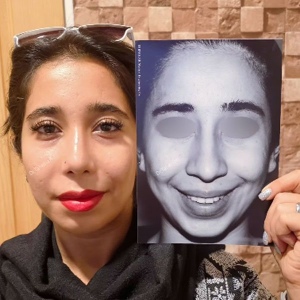 rhinoplasty821