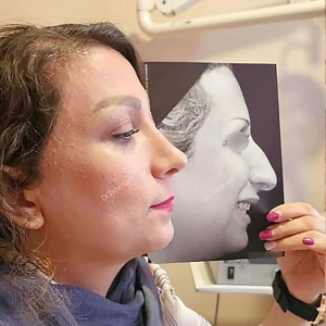 rhinoplasty822