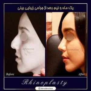 جراحی بینی استخوانی
