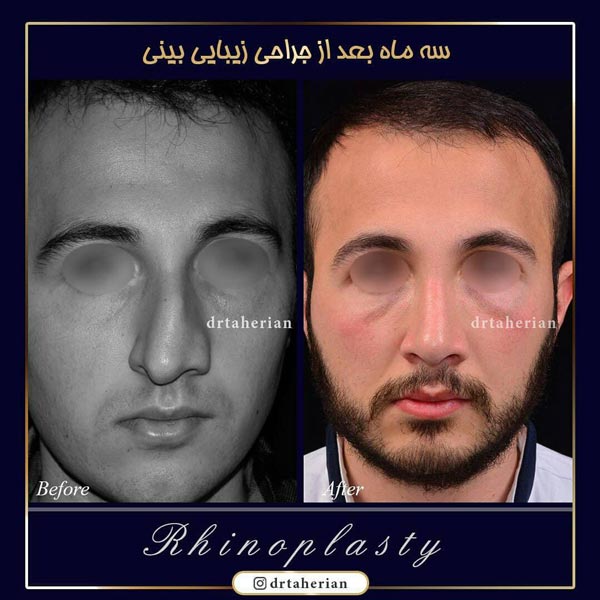 جراحی بینی - دکتر طاهریان