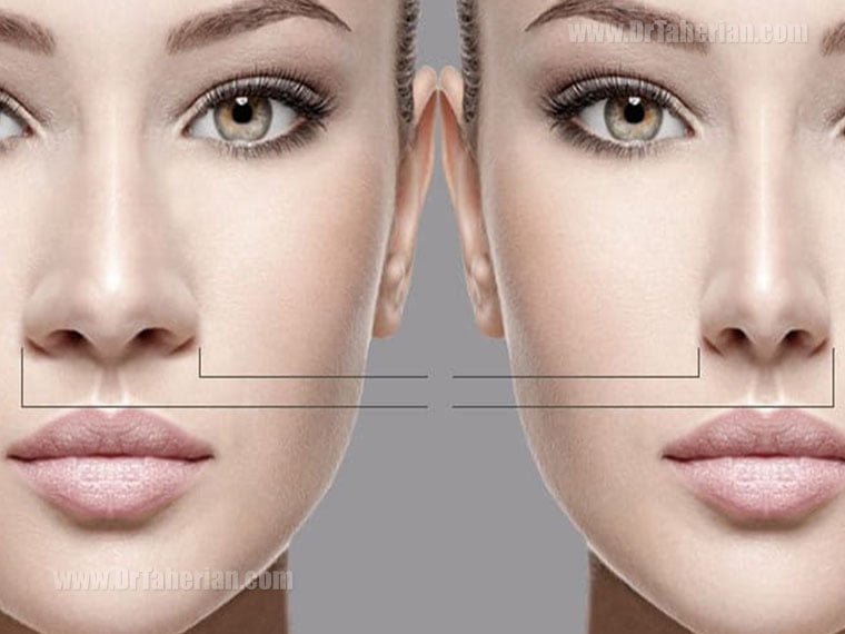 هزینه جراحی بینی 