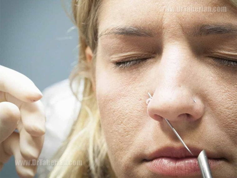 کارهای لازم قبل از جراحی بینی - خارج کردن پیرسینگ