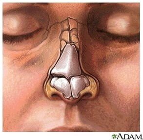 Nasal fractures