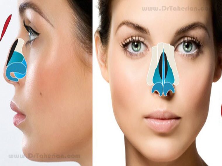 How rhinoplasty hump reduction is performed?