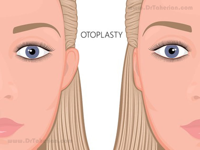 Different types of Otoplasty