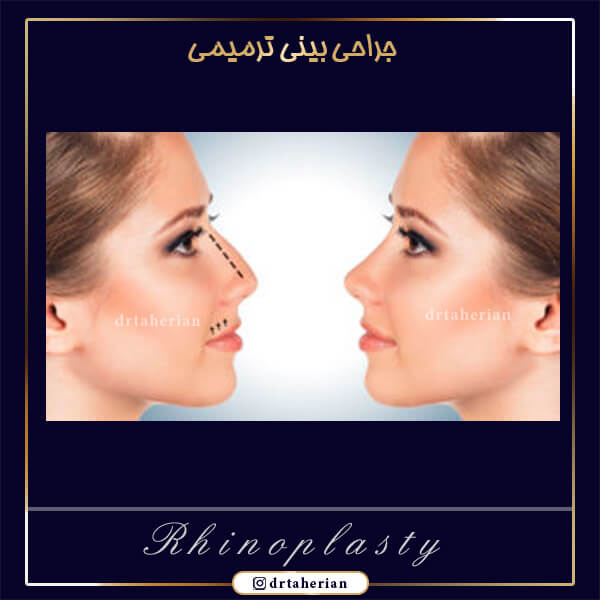 جراحی بینی ترمیمی - دکتر طاهریان