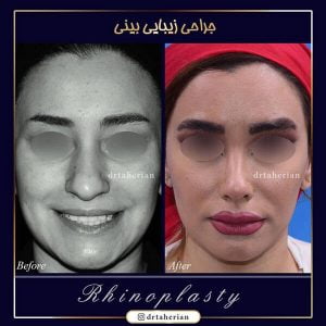 مراقبت های بعد از جراحی بینی - دکتر طاهریان