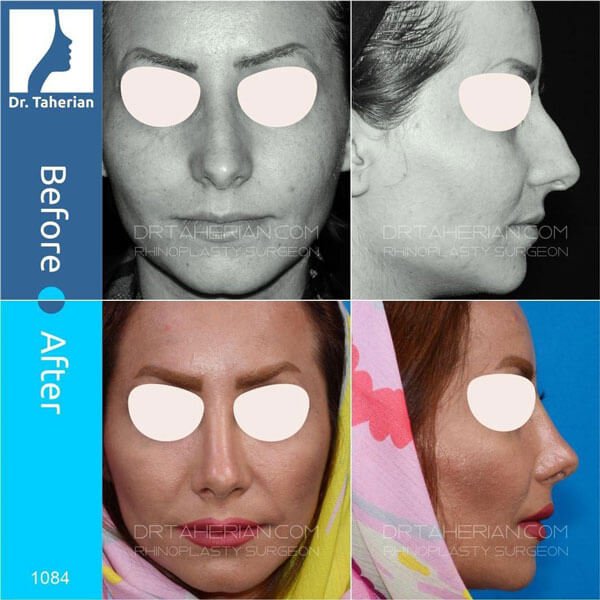 مراقبت های بعد از جراحی بینی - دکتر طاهریان