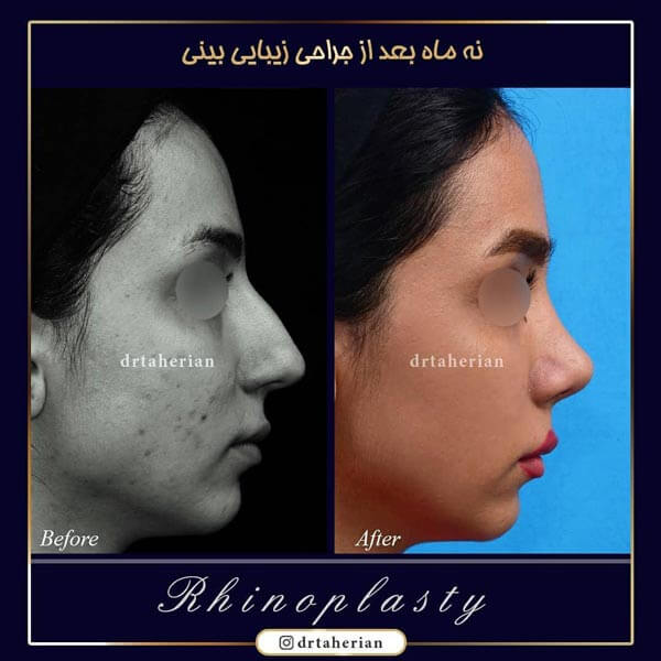 اقدامات قبل از جراحی بینی - دکتر طاهریان