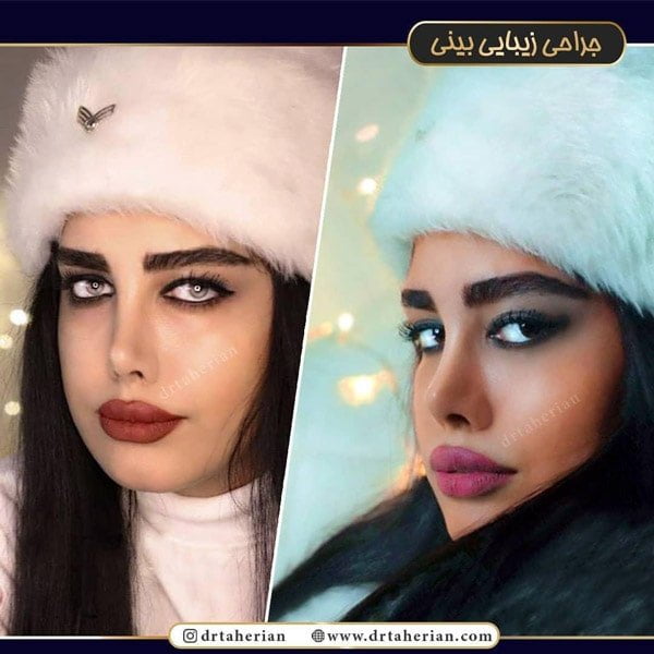 جراحی بینی نیمه فانتزی - دکتر طاهریان