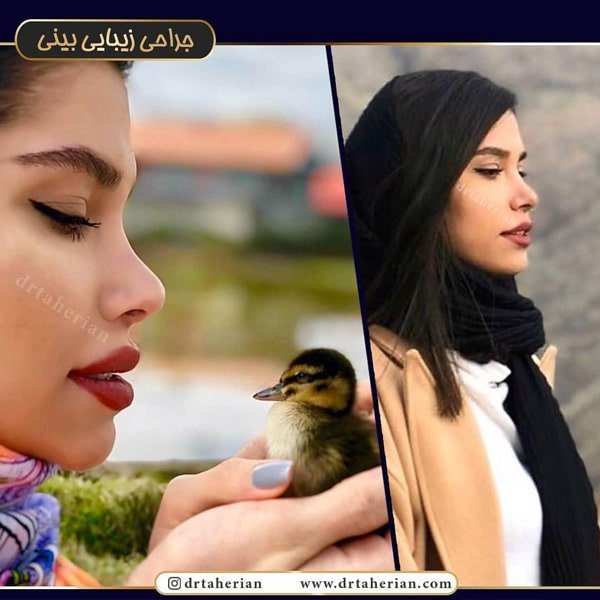 جراحی بینی نیمه فانتزی - دکتر طاهریان