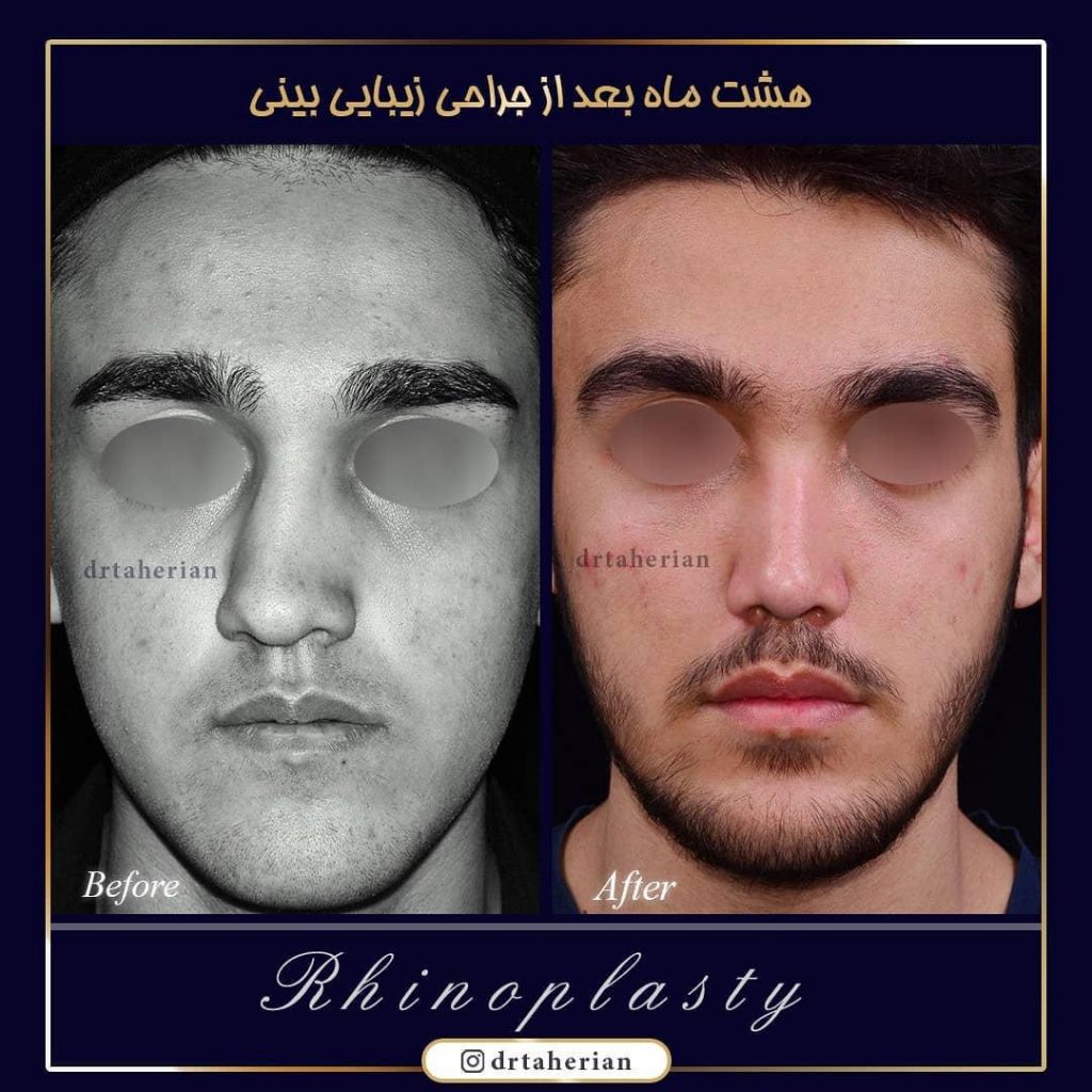 مراقبت های بعد از جراحی بینی