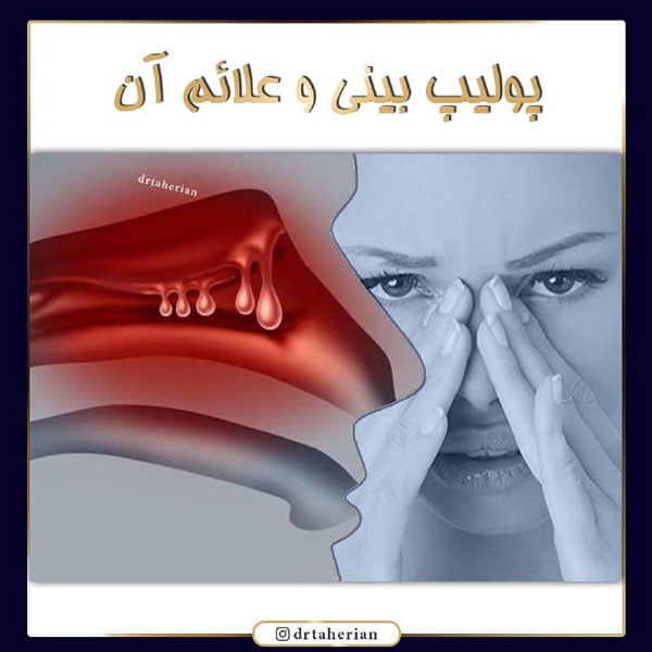 پولیپ بینی و راه های درمان آن با دکتر محمدحسین طاهریان