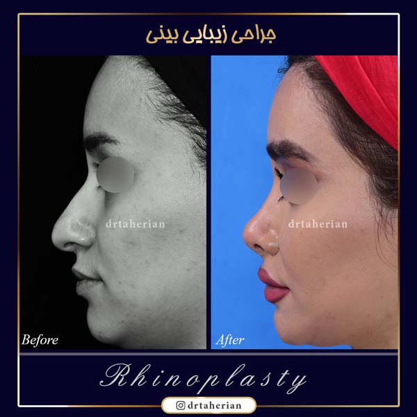 جراحی بینی نیمه فانتزی