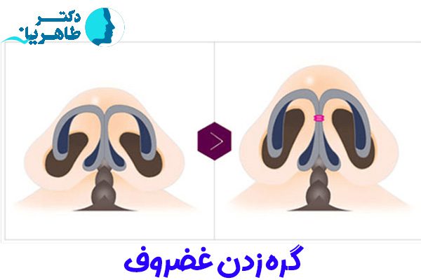 جراحی بینی + دکتر محمدحسین طاهریان