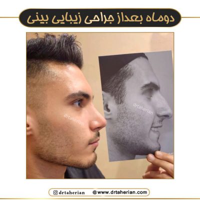 جراحی بینی طبیعی - دکتر طاهریان