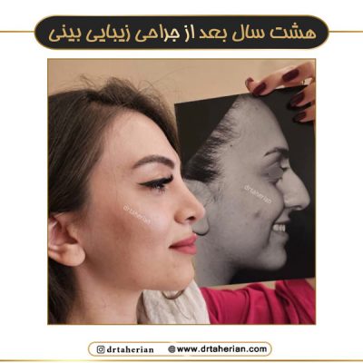 جراحی بینی طبیعی - دکتر طاهریان