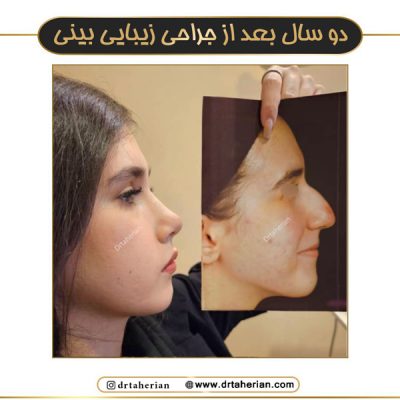 جراحی بینی طبیعی - دکتر طاهریان