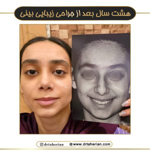 نمونه کار عمل بینی گوشتی - دکتر طاهریان