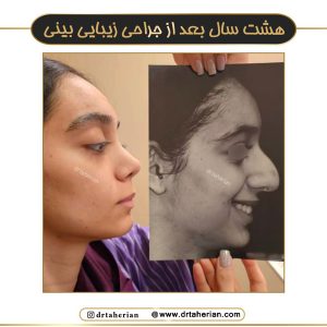 نمونه کار عمل بینی گوشتی - دکتر طاهریان