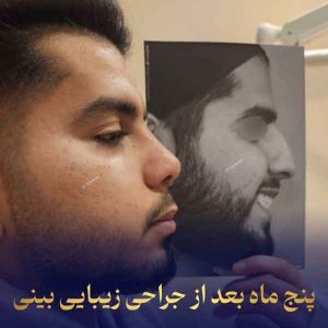 جراحی بینی طبیعی