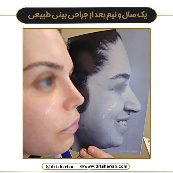 جراحی بینی دکتر طاهریان در تهران