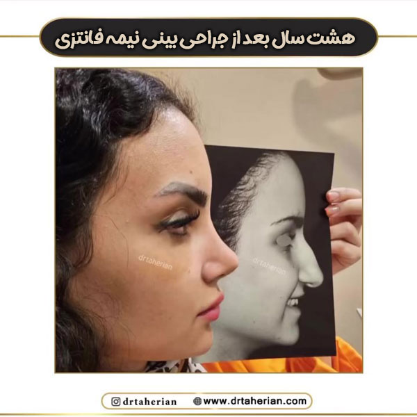 جراحی بینی دکتر طاهریان در تهران