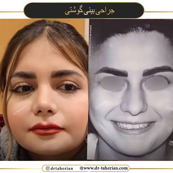 جراحی بینی گوشتی بهترین جراح بینی تهران در تهران
