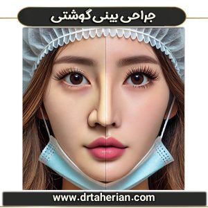 جراحی بینی گوشتی از دکتر محمدحسین طاهریان ، بهترین جراح بینی تهران