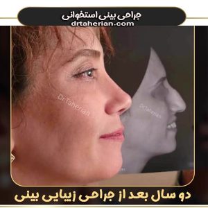 جراحی بینی استخوانی از دکتر محمدحسین طاهریان ، بهترین جراح بینی تهران