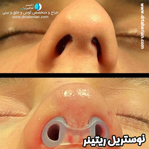 استفاده از نوستریل ریتینر با دکتر طاهریان