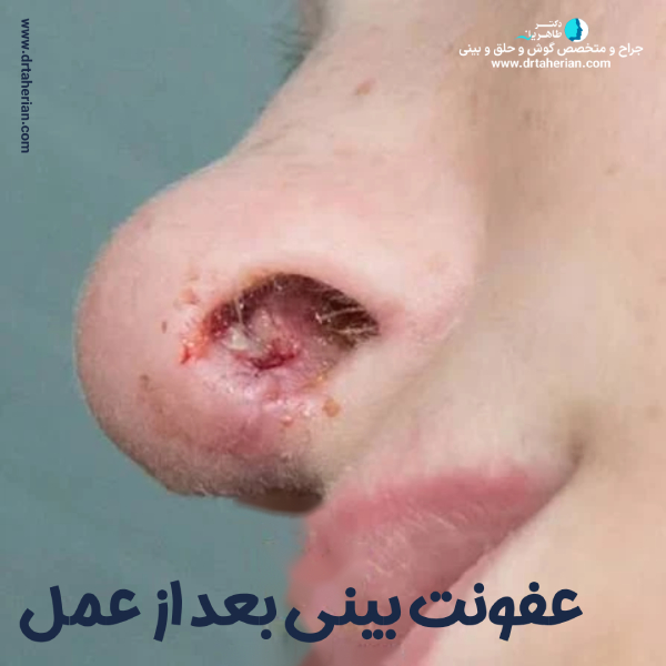 عفونت پس از جراحی بینی